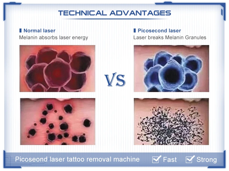 2 years warranty portable  picosecond 532nm 1064nm 1320nm 755nm yag laser machine