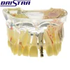 Implant disease teeth model for medical sicence/dental implant model