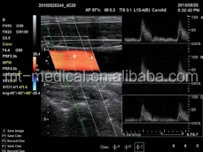 Ultrasound Cart Medical Equipment Portable Scanner