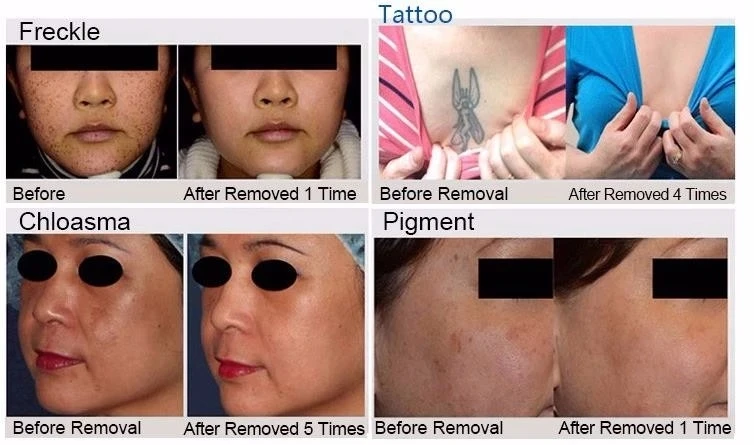 Unique Real Pico! USA Lambda Honeycomb Lens Tattoo Removal Pico Laser For Wrinkles Acne