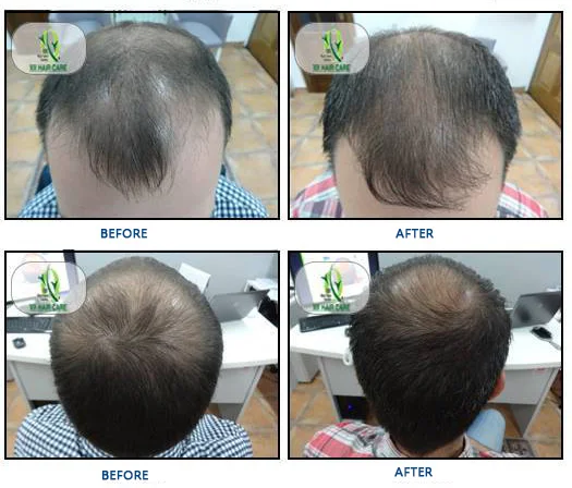 low level laser therapy hair growth