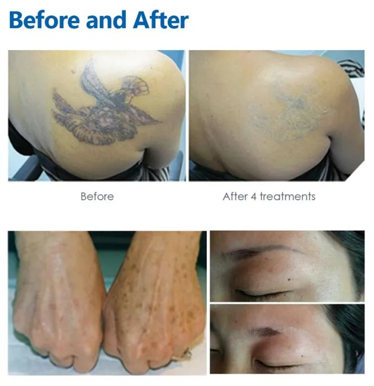 Самонастраивающаяся Ручка Nd Yag,Запасные Части Для Лазерной Машинки Для Удалени