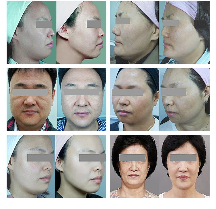 Newest Korea A0226 vmax hifu Face Lift Body Shaping Machine / Hifu Doublo Hironic co Machine