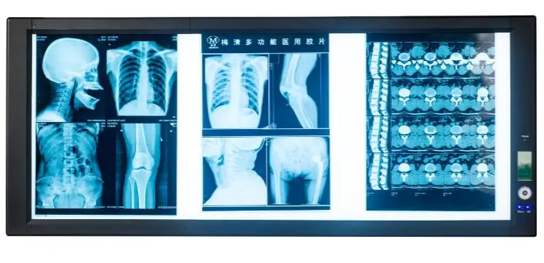 Portable Medical Led X Ray Negatoscope Triple Machine