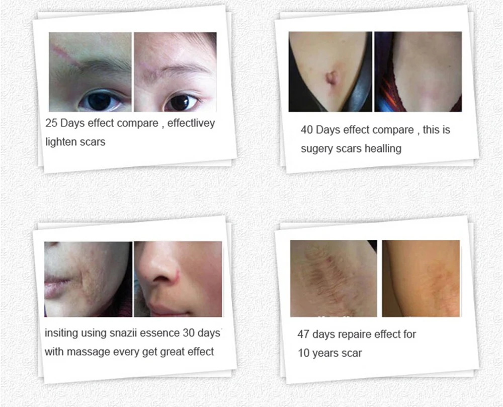 New Hot Nuobisong Facial Scar Removal Cremas Facial Spots Treatment