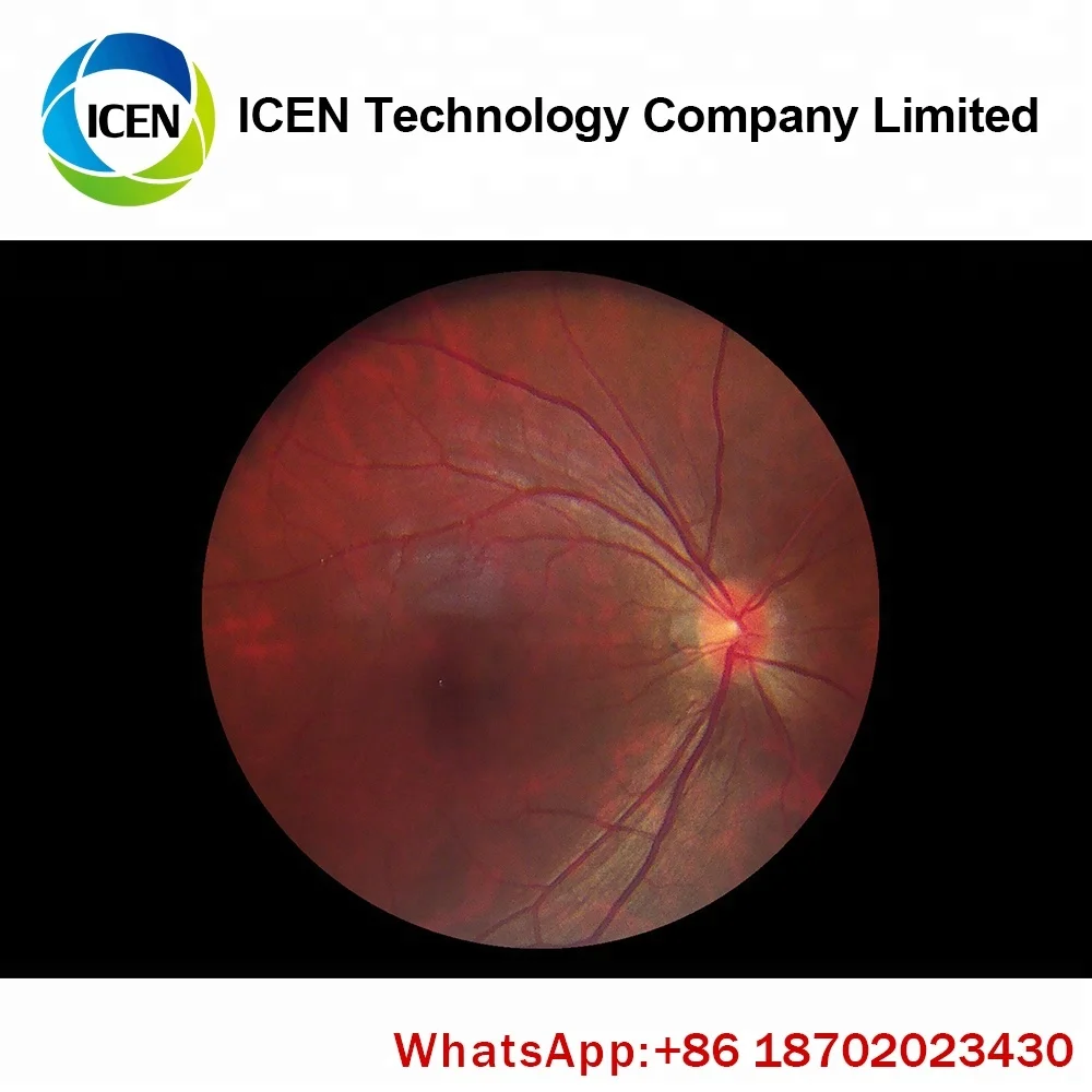handheld fundus camera