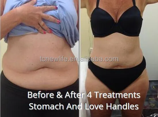 Cavitation effect RUV500