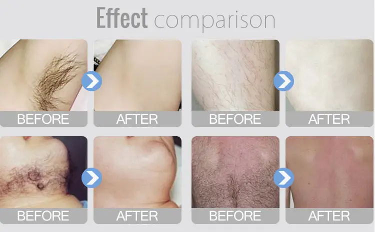 Best Quality Body 755 1064 Laser Hair Removal Diode 808