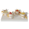 medical simulation model type and human plastic skeleton model /Vertebrae diseased model