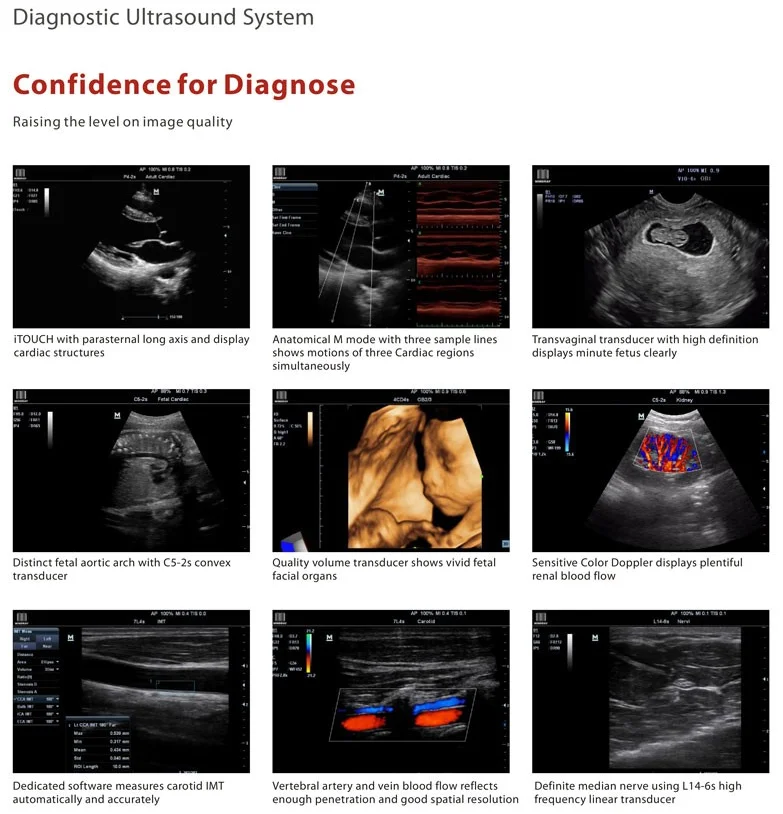 Portable 3D Doppler Ultrasound Machine Ultrasonography