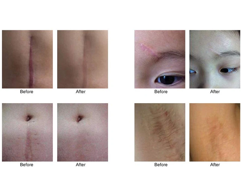 silica gel scar sheet