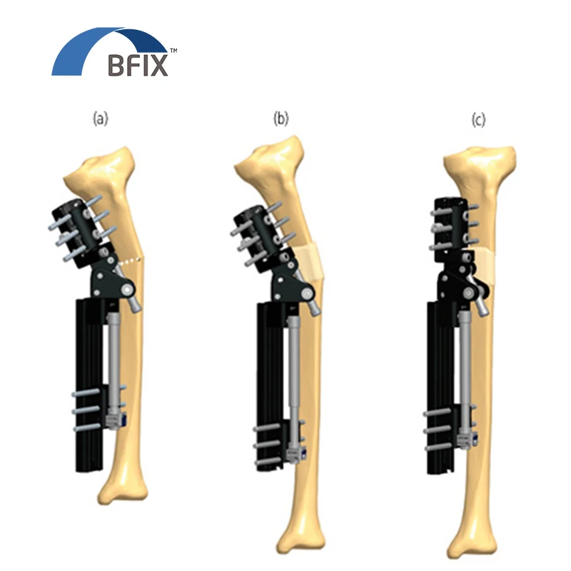 Acute Shortening And Angular Correction By Callus Manipulation Further