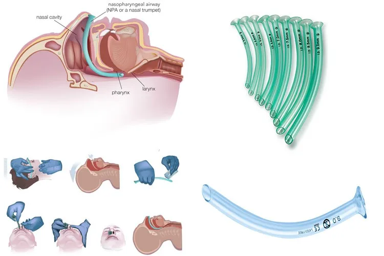 Medical Pvc Nasopharyngeal Airway For Nasal Hose - Buy Pvc ...