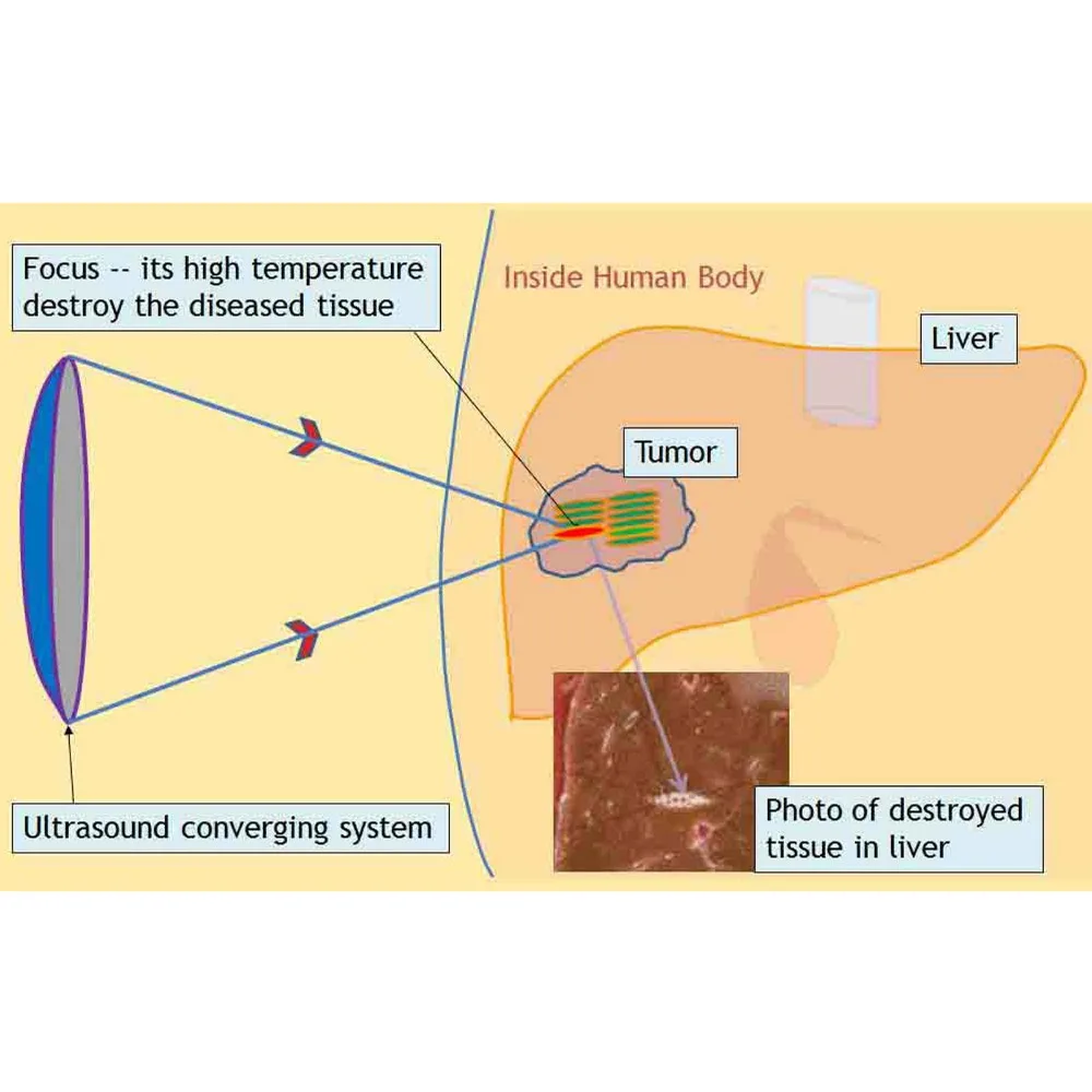 tratamiento del cáncer de próstata hifu en india tratamiento del cáncer de próstata hifu en india