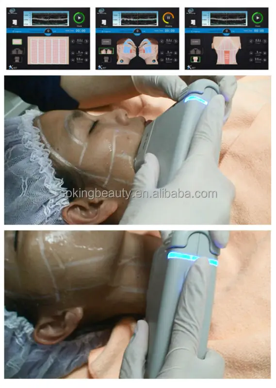 FU4.5-2S Facial skin tightening high intensity focused ultrasound for wrinkle removal