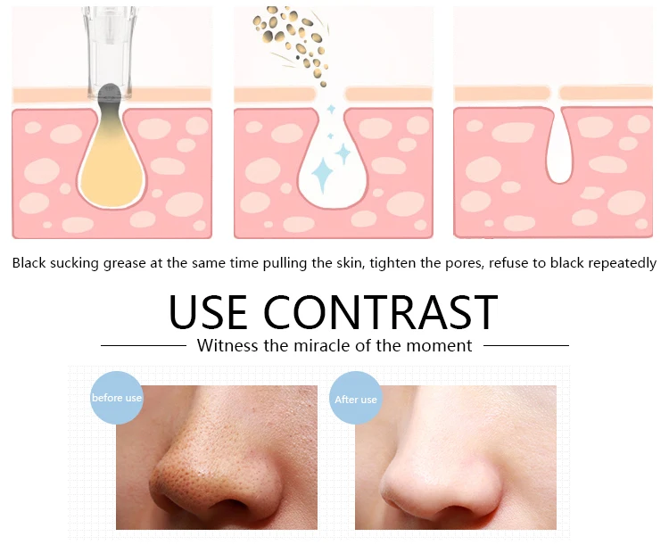 High quality good black head vacuum electric blackhead acne remover