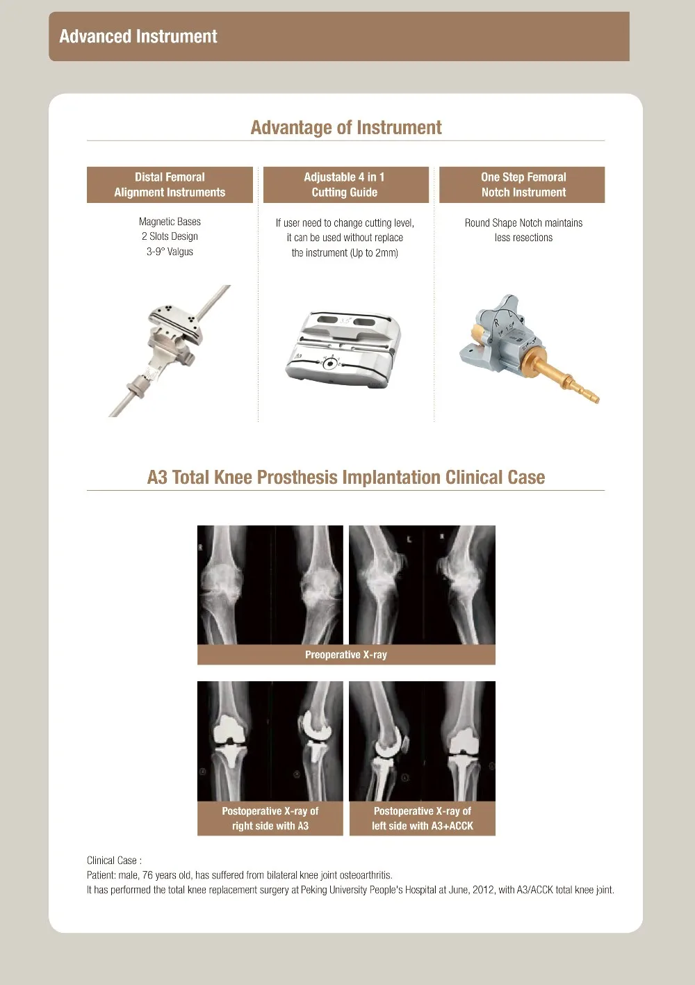 Био имплант коленного сустава. ГОСТ коленные имплантаты. Total Knee Replacement Surgery Case study. Коленный имплант Зиннер-характеристики.