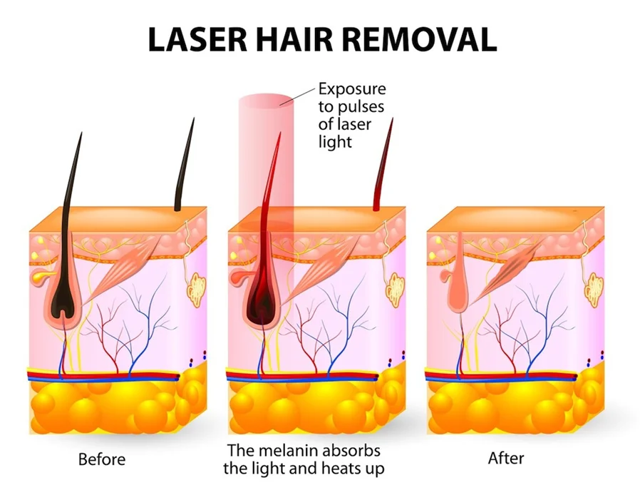 755nm 808nm 1064nm Vertical diode laser hair removal machine,alexandrite laser depilation