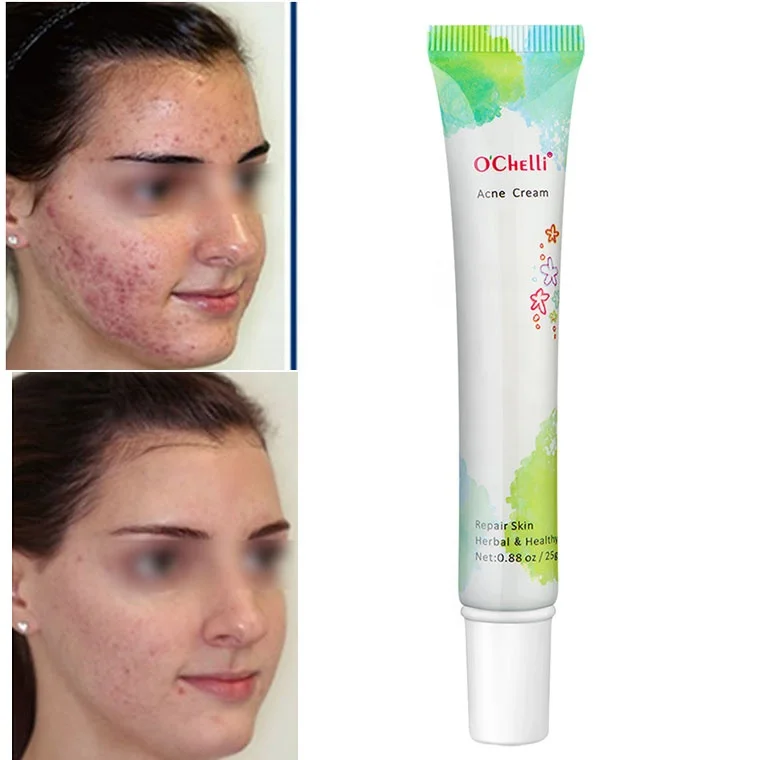 

ONE DAY CAN SEE RESULT Oil Control Acne Treatment Elica Cream For Acne