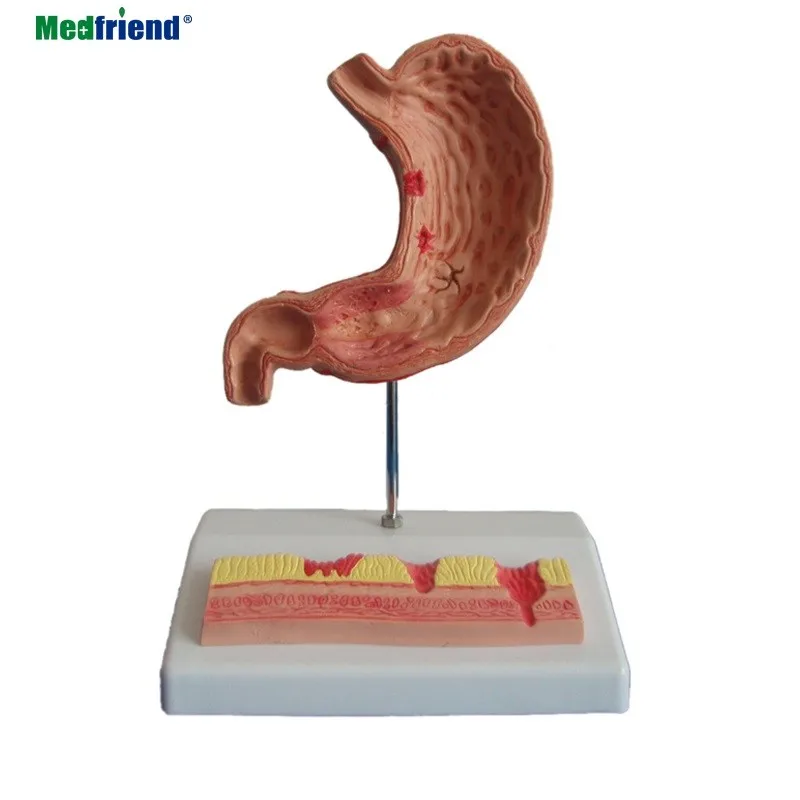 与溃疡模型的医学解剖胃