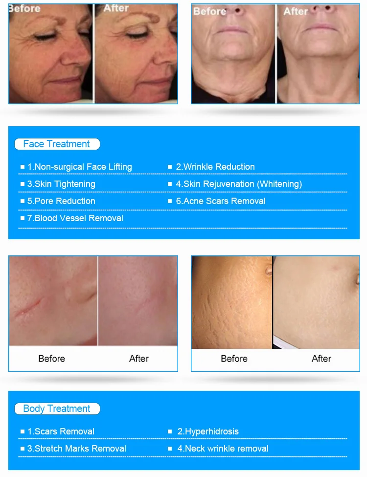 Portable gold microneedle rf fractional rf microneedle rf beauty machine