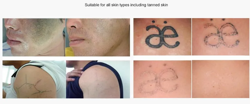 Лазер Для Удаления Тату Цена