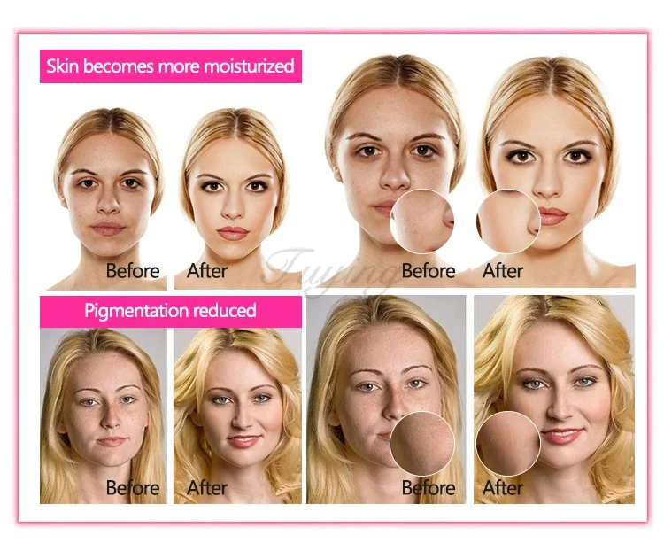 Derma pen (13).jpg