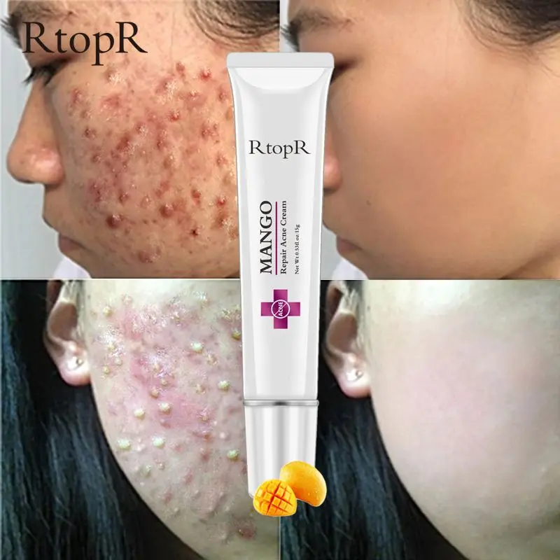 

Acne Scar Stretch Marks Remover Cream Skin Repair Face Cream Acne Spots Acne Treatment Blackhead Whitening Cream