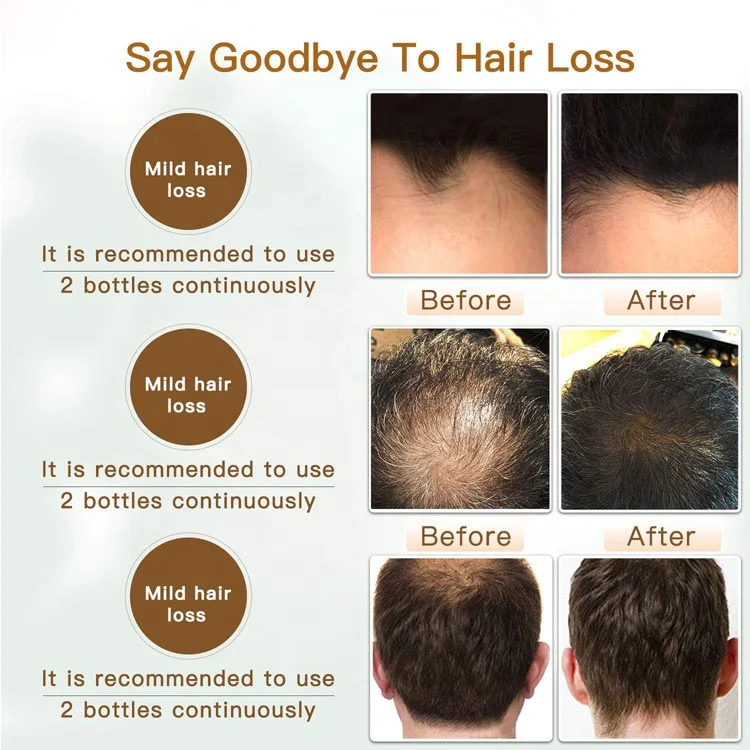 
Private Label Natural Anti Hair Loss Spray OEM Hair Growth Serum Grow Hair Care Serum 