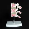 Human anatomy vertebrae osteoporosis medical anatomical model