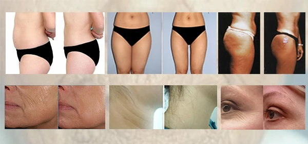 Кавитация живота отзывы до и после фото Faltenbehandlung radiofrecuencia indiba Alibaba.com