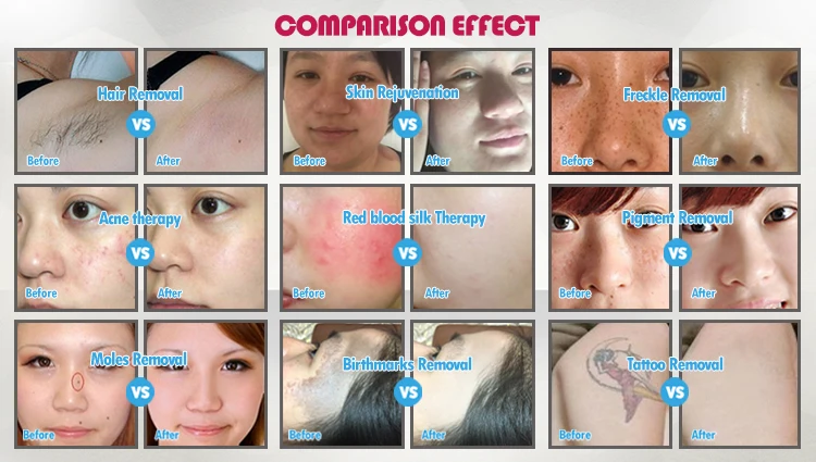 removing wrinkles. 6. treat dilated vessels