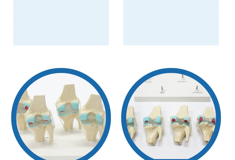 4 Stage Osteoarthritis Knee Model - Educational Tool
