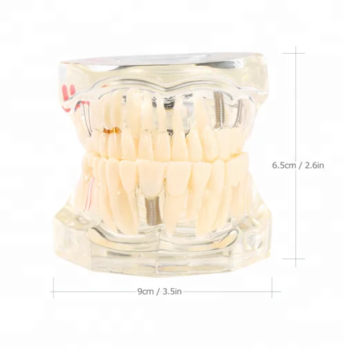
Hot Sale Resin Dental Implant Model 