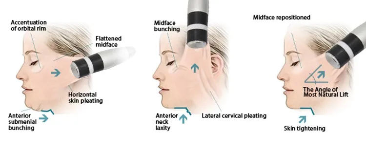 Cryo mesontherapy 4