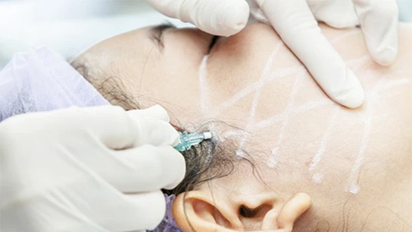 Нити при морщинах - Морщины морщины Избавляемся нитями молодости! - Убрать морщи