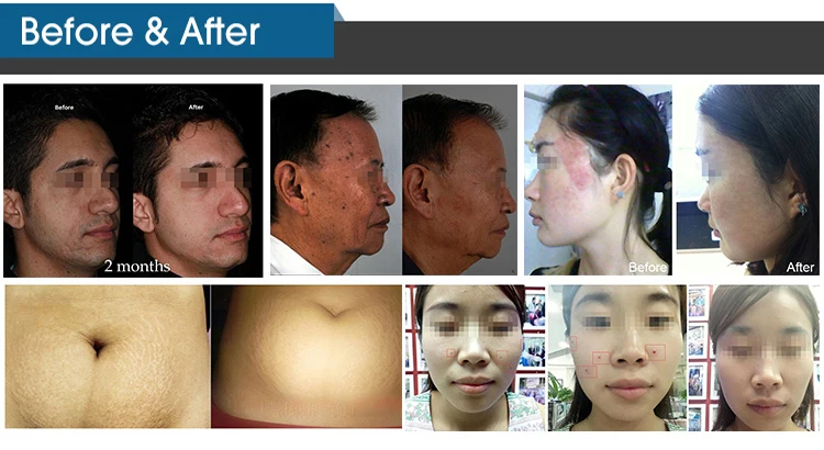 CO2 laser Fractional Vaginal Tightening machine/Stretch Mark Removal