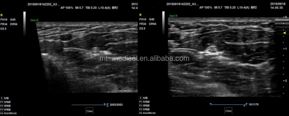 Ultrasound Cart Medical Equipment Portable Scanner