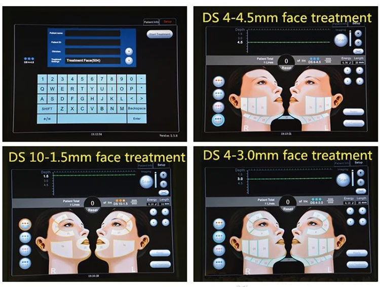 Anti-wrinkle Skin Tightening Face Lifting Anti Aging HIFU Machine for Spa