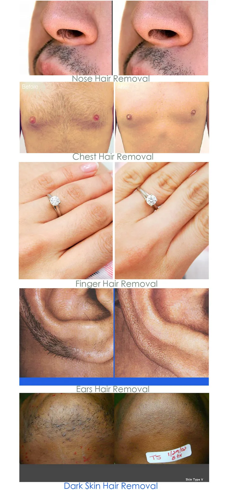 nose hair laser