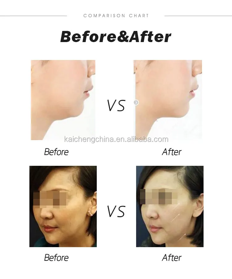 eye lifting beauty machine