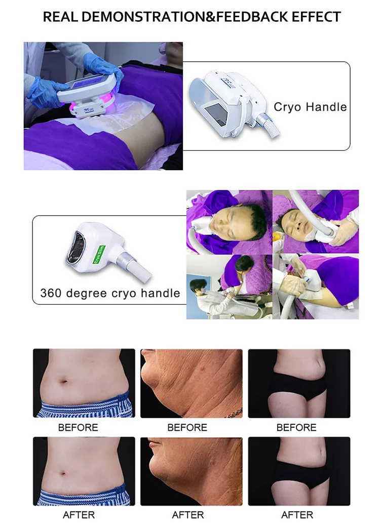 New professional fat freezing slimming cryo machine factory price