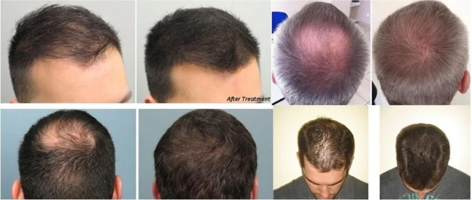 Пересадка волос выпадают волосы. Трансплантация волос на макушке. До и после пересадки волос. Пересаживание луковиц волос.