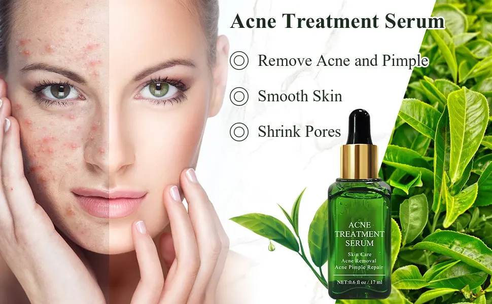 severe acne treatment