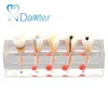 high quality of endodontic treatment model for demonstrating 5 stages of root canal procedure on second premolar