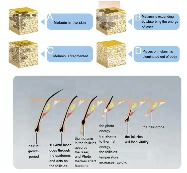 Newest 1064 Fiber Coupled Long Pulse Nd Yag Laser Hair Removal Buy Nd