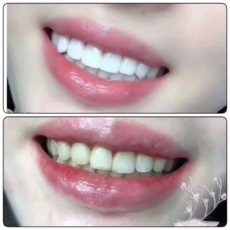 批准家庭蓝光牙齿美白套装与牙齿美白笔和牙齿美白 led 家庭牙齿美白