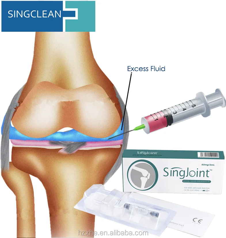 Укол гиалуроновой кислоты в сустав коленный. Укол в колено гиалуроновой. Уколы в коленный сустав с гиалуроновой кислотой. Введение гиалуроновой кислоты в сустав. Гиалуронка для суставов уколы.