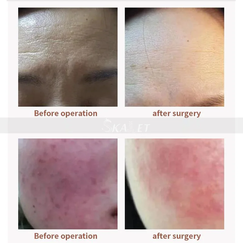 Professional Non-invasive Wrinkle Remover anti-bacterial with CE