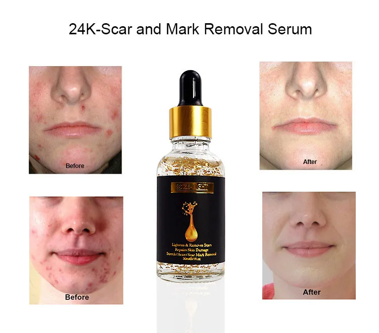 Private Label 24k Gold Anti Acne Scar Serum Stretch Mark Removal Serum